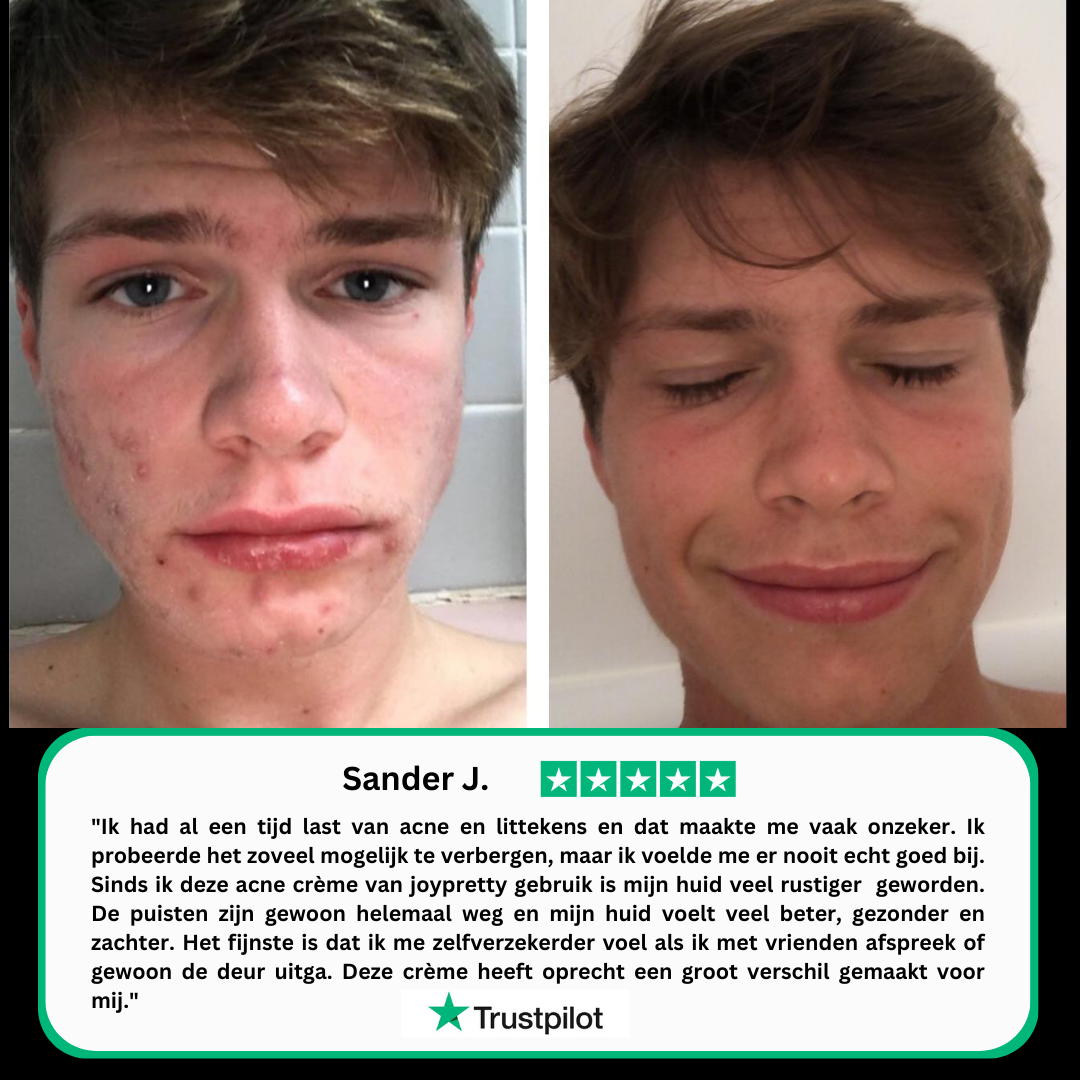 Acne crème