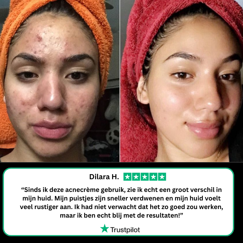 Acne crème